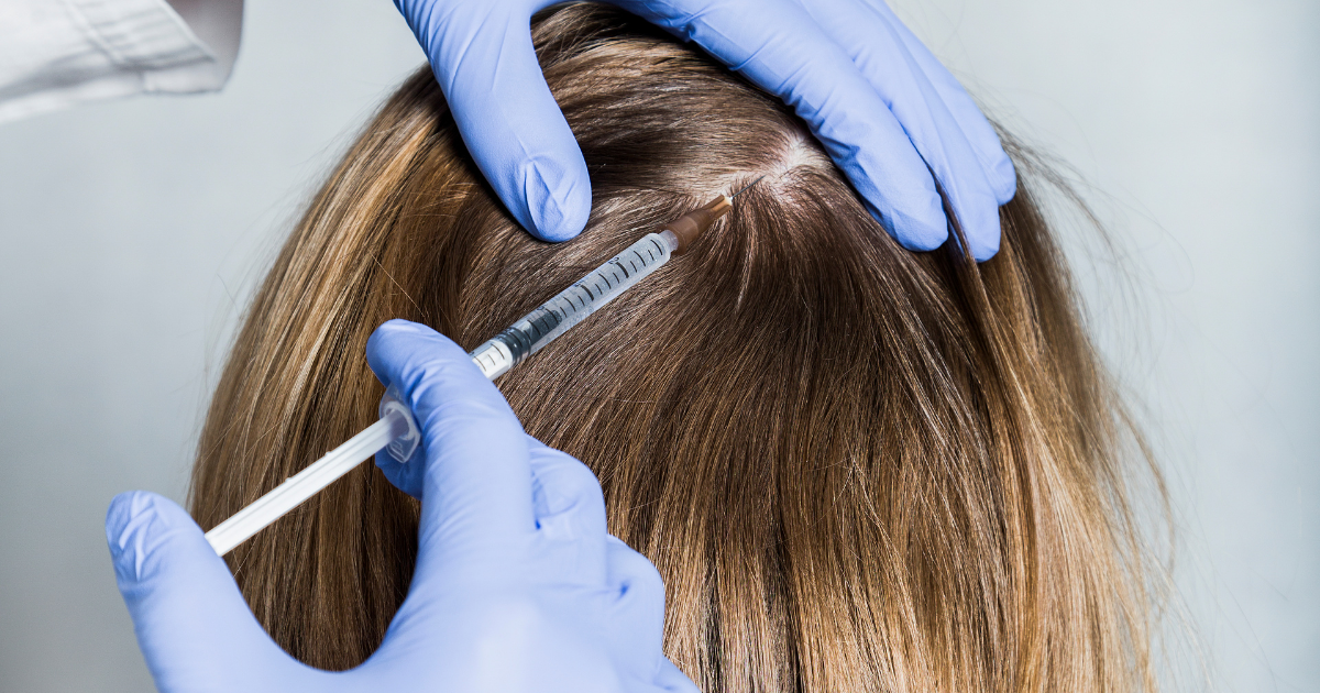 tratamientos contra la alopecia femenina